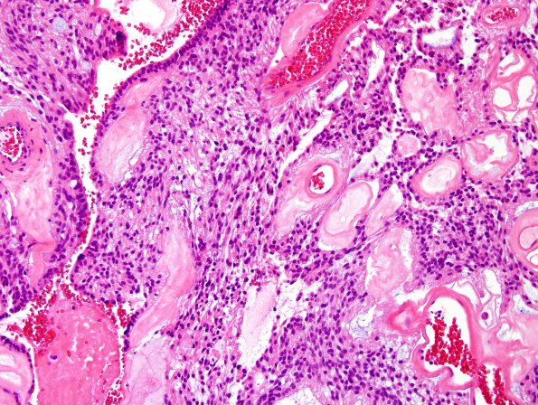 2C3 Ependymoma, myxopapillary (Case 2) H&E 3.jpg