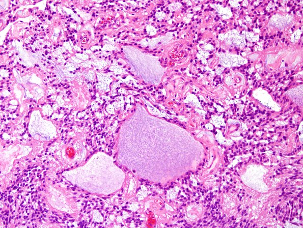 2C4 Ependymoma, myxopapillary (Case 2) H&E 5.jpg