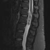 3A Ependymoma, myxopapillary (Case 3) STIR - Copy