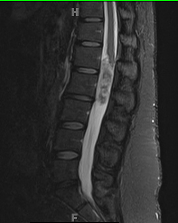 3A Ependymoma, myxopapillary (Case 3) STIR - Copy