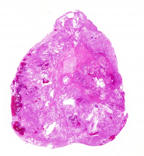 3B1 Ependymoma, myxopapillary (Case 3) 1 H&E WM