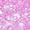 3B2 Ependymoma, myxopapillary (Case 3) H&E 1.jpg