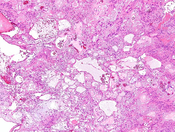 3B2 Ependymoma, myxopapillary (Case 3) H&E 1.jpg