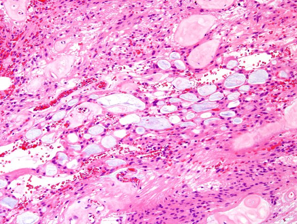 3B3 Ependymoma, myxopapillary (Case 3) H&E 3.jpg