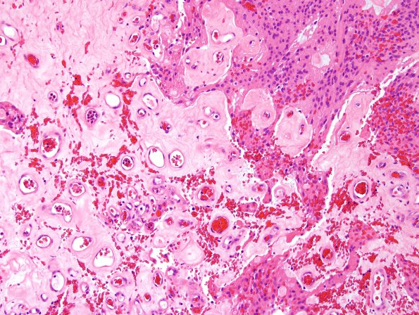 3B4 Ependymoma, myxopapillary (Case 3) H&E 4.jpg