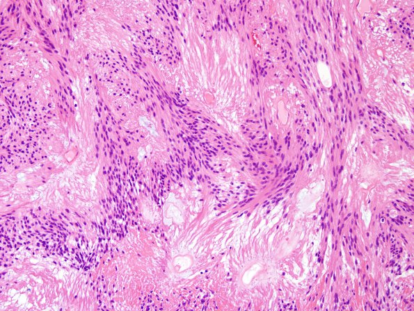 3B5 Ependymoma, myxopapillary (Case 3) H&E 8.jpg