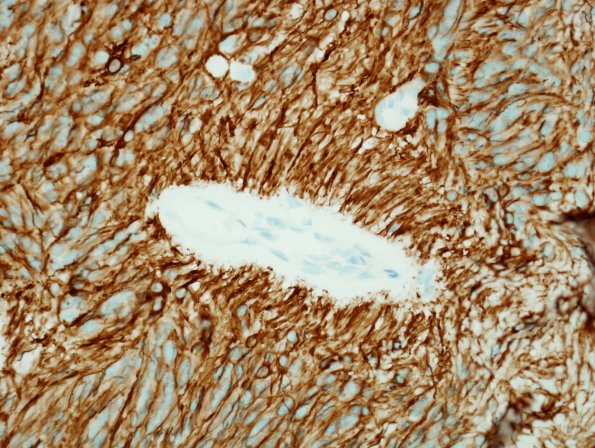 3C2 Ependymoma, myxopapillary (Case 3) GFAP 1.jpg