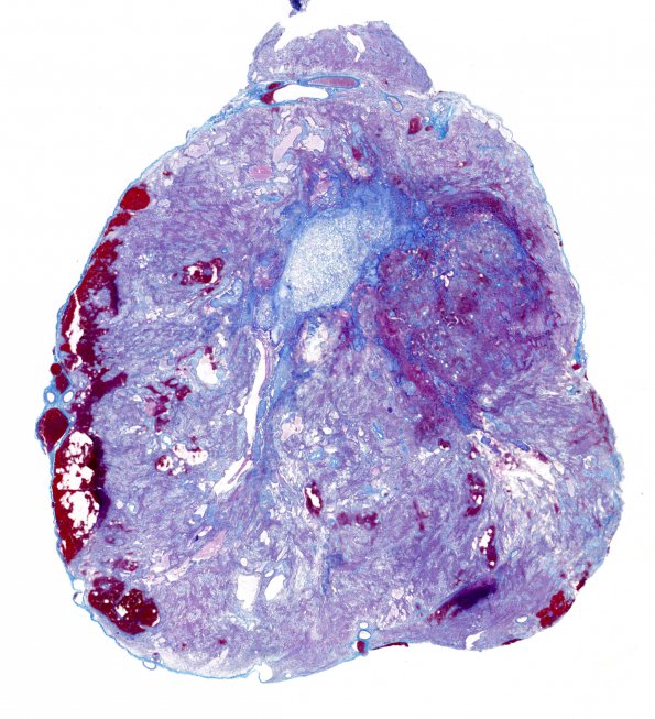 3E1 Ependymoma, myxopapillary (Case 3) 1 Trichrome WM