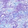 3E2 Ependymoma, myxopapillary (Case 3) Trichrome 1.jpg