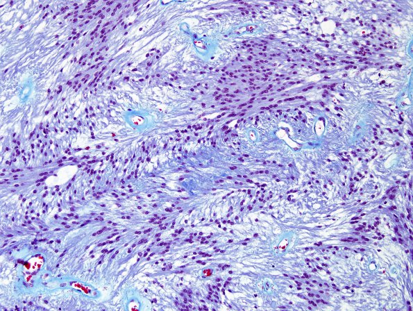 3E2 Ependymoma, myxopapillary (Case 3) Trichrome 1.jpg