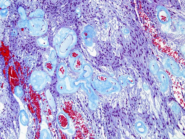 3E4 Ependymoma, myxopapillary (Case 3) Trichrome 3.jpg