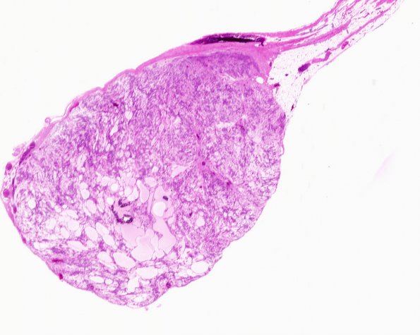 4B1 Ependymoma, myxopapillary (Case 4) H&E WM