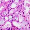 4B2 Ependymoma, myxopapillary (Case 4) H&E 1