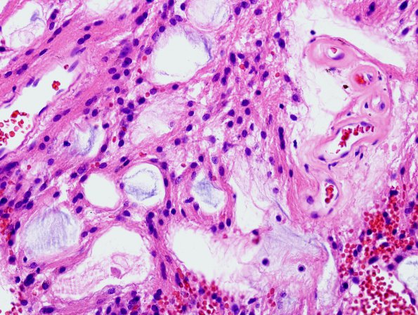 4B2 Ependymoma, myxopapillary (Case 4) H&E 1