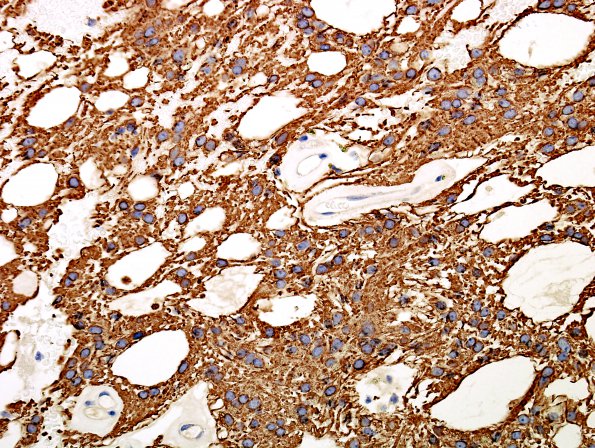 4C Ependymoma, myxopapillary (Case 4) GFAP