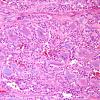 5A1 Ependymoma, myxopapillary (presacral, 6 yo, Case 5) H&E 6.jpg