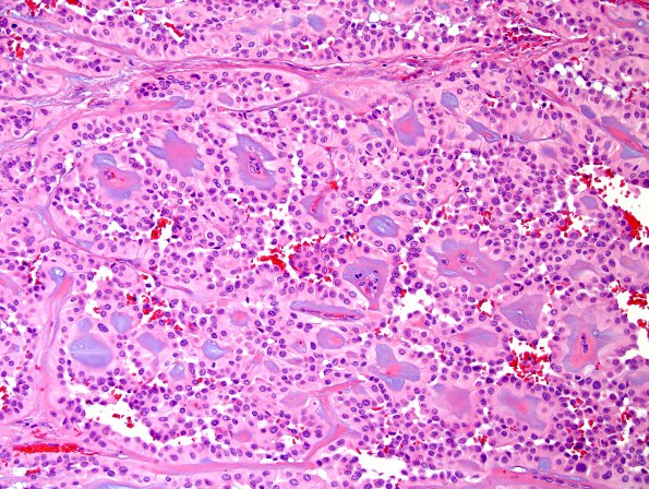 5A1 Ependymoma, myxopapillary (presacral, 6 yo, Case 5) H&E 6.jpg