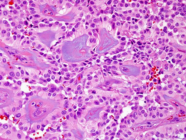 5A2 Ependymoma, myxopapillary (presacral, 6 yo, Case 5) H&E 1.jpg