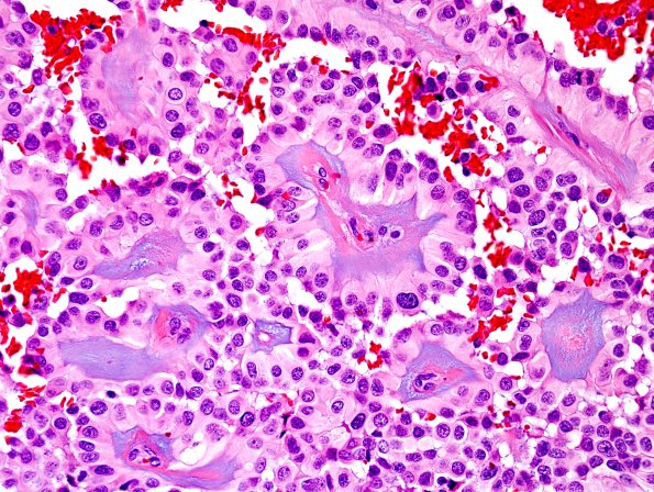 5A3 Ependymoma, myxopapillary (presacral, 6 yo, Case 5) H&E 2.jpg