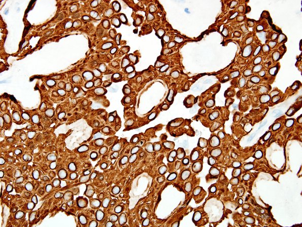 5B2 Ependymoma, myxopapillary (presacral, 6 yo, Case 5) GFAP 60X.jpg