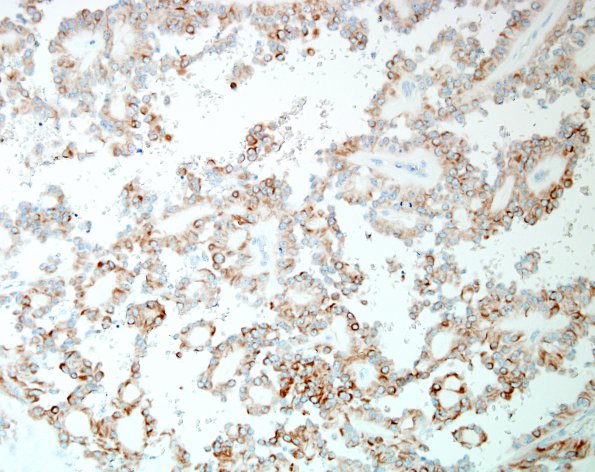 5C1 Ependymoma, myxopapillary (presacral, 6 yo, Case 5) CK 2 (2).jpg