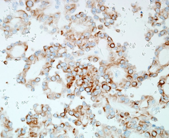 5C2 Ependymoma, myxopapillary (presacral, 6 yo, Case 5) CK 1 (2).jpg