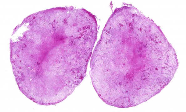 6A1 Ependymoma, myxopapillary (Case 6) 1 H&E WM