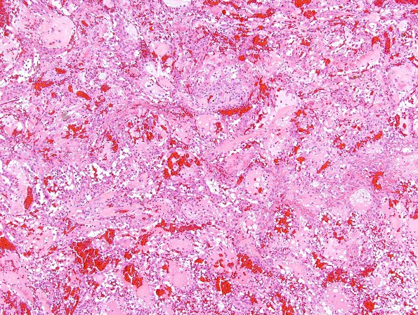 6A2 Ependymoma, myxopapillary (Case 6) H&E 6