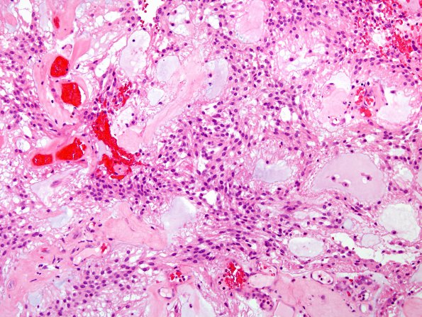 6A3 Ependymoma, myxopapillary (Case 6) H&E 1