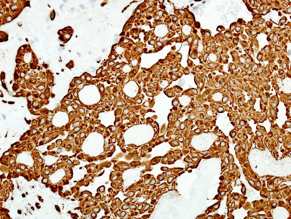 6B2 Ependymoma, myxopapillary (Case 6) GFAP 3