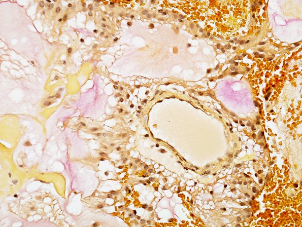 6C2 Ependymoma, myxopapillary (Case 6) Mucicarmine 2