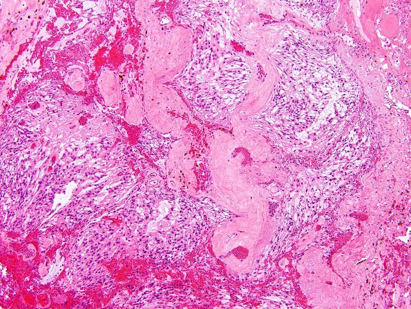 7A1 Ependymoma, myxopapillary, anaplastic fx (Case 7) - H&E representative 4 - low powerA.jpg