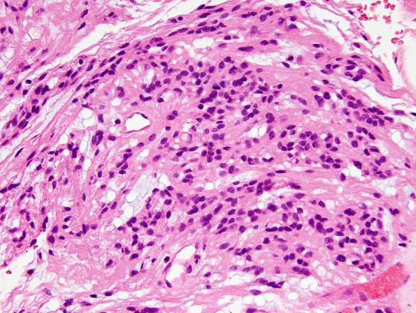 7A2 Ependymoma, myxopapillary, anaplastic fx (Case 7) - H&E representative 1.jpg