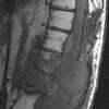 7B1 Ependymoma, myxopapillary, anaplastic fx (Case 7) -MRI T1 pre - Copy (2)