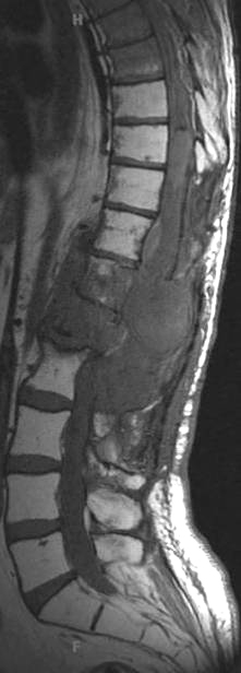 7B1 Ependymoma, myxopapillary, anaplastic fx (Case 7) -MRI T1 pre - Copy (2)