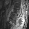 7B2 Ependymoma, myxopapillary, anaplastic fx (Case 7) -MRI T1post - Copy