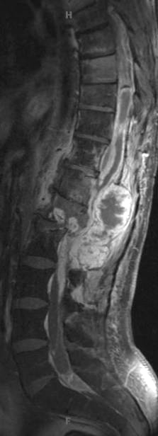 7B2 Ependymoma, myxopapillary, anaplastic fx (Case 7) -MRI T1post - Copy