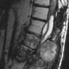 7B3 Ependymoma, myxopapillary, anaplastic fx (Case 7) -MRI T2 - Copy