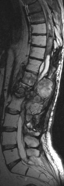 7B3 Ependymoma, myxopapillary, anaplastic fx (Case 7) -MRI T2 - Copy