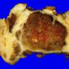 7C1 Ependymoma, myxopapillary, agressive recurrent (Case 7) gross 1