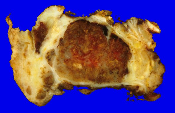 7C1 Ependymoma, myxopapillary, agressive recurrent (Case 7) gross 1