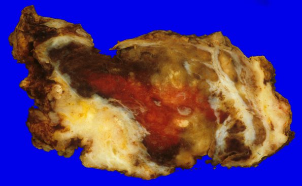 7C2 Ependymoma, myxopapillary, agressive recurrent (Case 7) gross 2