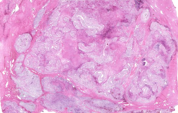 7D1 Ependymoma, myxopapillary (Case 7) H&E WM