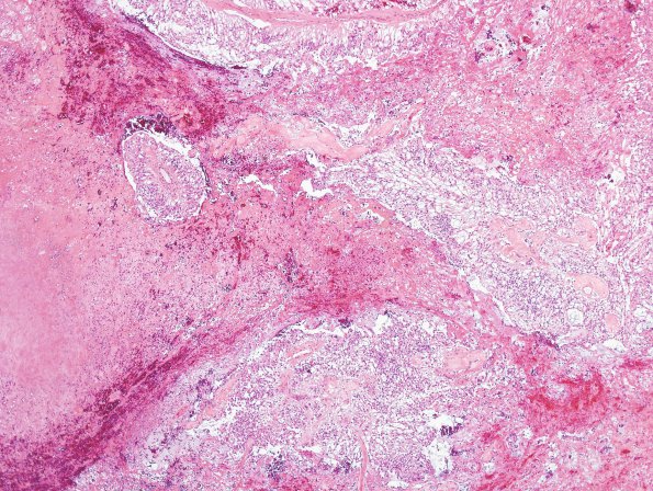 7D2 Ependymoma, myxopapillary (Case 7) H&E 2 A