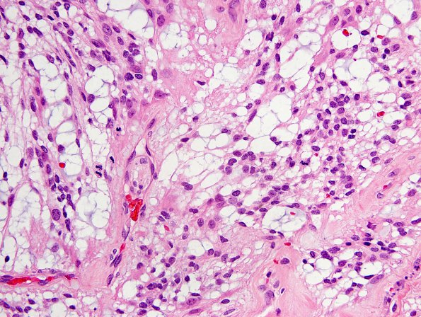 7D3 Ependymoma, myxopapillary, anaplastic fx (Case 7) - H&E mits 2A.jpg