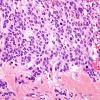 7D4 Ependymoma, myxopapillary & Anaplasia (Case 7) H&EA