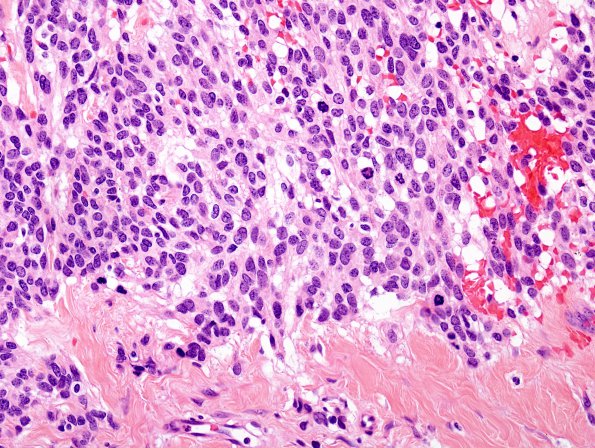 7D4 Ependymoma, myxopapillary & Anaplasia (Case 7) H&EA