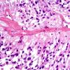 7D5 Ependymoma, myxopapillary, anaplastic fx (Case 7) - FS 1A.jpg