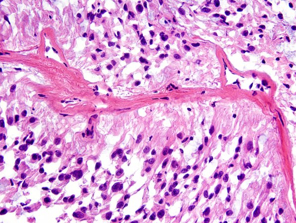 7D5 Ependymoma, myxopapillary, anaplastic fx (Case 7) - FS 1A.jpg