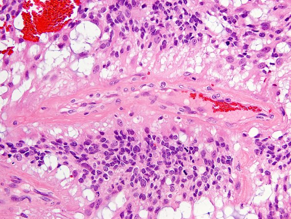 7D6 Ependymoma, myxopapillary, anaplastic fx (Case 7) - H&E mits 1A.jpg